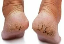 फटी एड़ियों का घरेलू उपाय…. Cracked heels